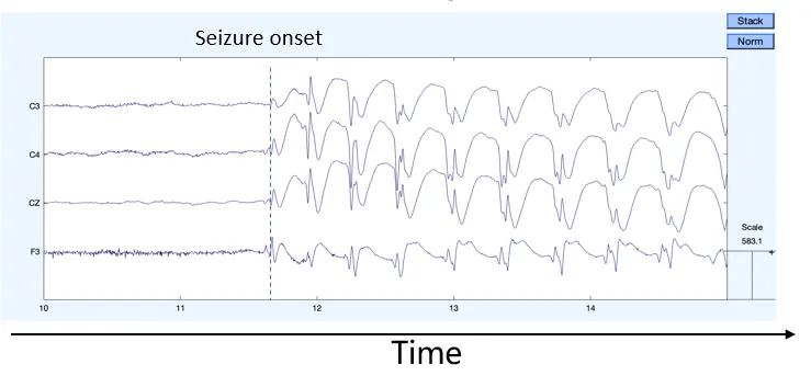 EEG recording