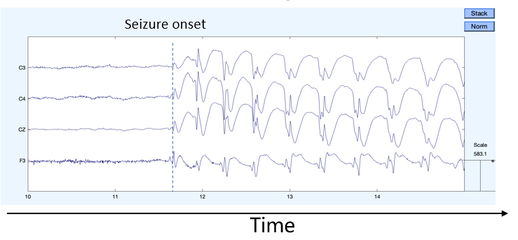 EEG recording